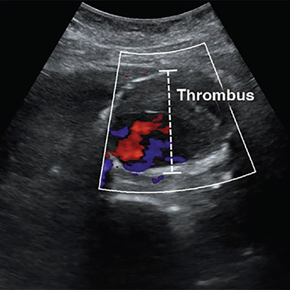 Acute Abdomen: Point-of-Care Ultrasound