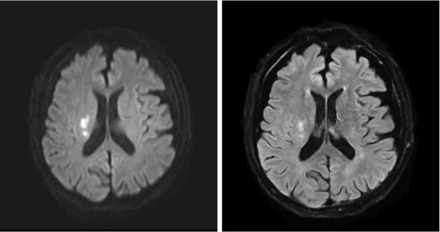 Why Ultrafast MRI Is the Future of Acute Stroke Triage